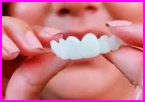 مزیت لمینت متحرک دندان دوپکا چیست 